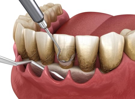 Photo for Open curettage: Scaling and root planing (conventional periodontal therapy). Medically accurate 3D illustration of human teeth treatment - Royalty Free Image