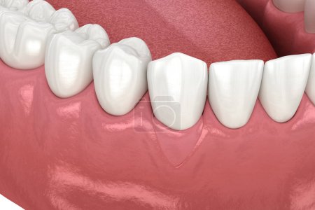 Foto de Recesión de encías: Cirugía de injerto de tejido blando. Ilustración 3D del tratamiento dental - Imagen libre de derechos