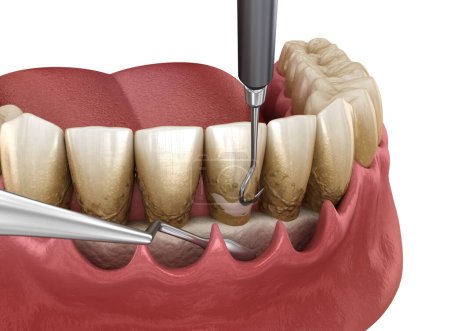 Foto de Curetaje abierto: Escalado y cepillado radicular (terapia periodontal convencional). Ilustración 3D médicamente precisa del tratamiento de dientes humanos - Imagen libre de derechos