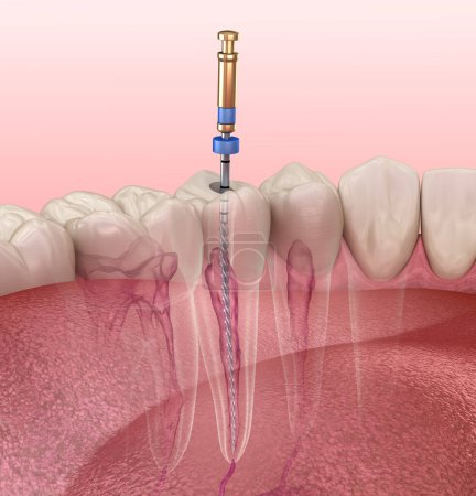 Tratamiento endodóntico del conducto radicular. Ilustración 3D de dientes médicamente precisos.