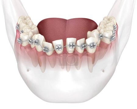 Posición anormal de los dientes y corrección con rodilleras metálicas tretament. Ilustración dental 3D médicamente precisa