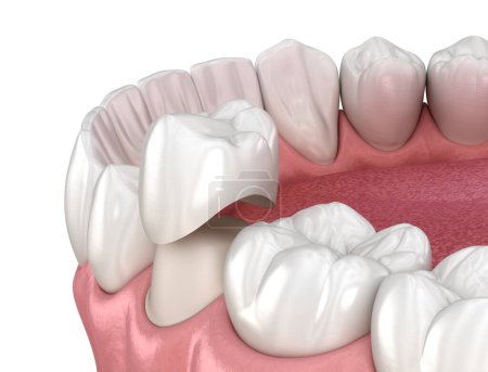 Téléchargez les photos : Préparation de la dent prémolaire et placement de la couronne dentaire. Illustration 3D médicalement précise - en image libre de droit