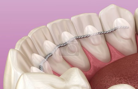 Téléchargez les photos : Retainers dentaires installés après le traitement des accolades, illustration 3D dentaire médicalement précise - en image libre de droit