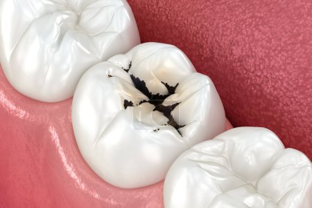 Téléchargez les photos : Dents molaires endommagées par la carie. Illustration 3D dentaire médicalement précise. - en image libre de droit