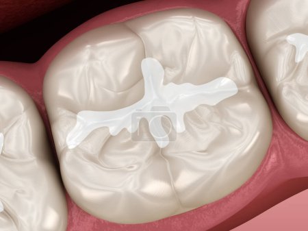 Photo for Molar Fissure dental fillings. Dental 3D illustration - Royalty Free Image