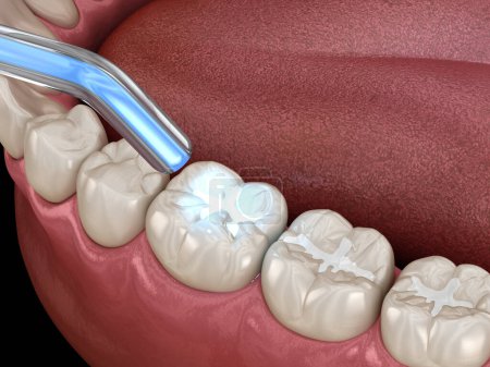 Zahnsanierung mit Füllung und Polymerisationslampe. Zahnärztliche 3D-Illustration