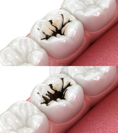 Téléchargez les photos : Dent molaire et progression des caries. Illustration 3D dentaire médicalement précise - en image libre de droit