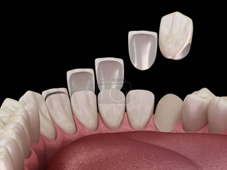 Photo for Dental veneer placement procedure. Dental 3D illustration - Royalty Free Image