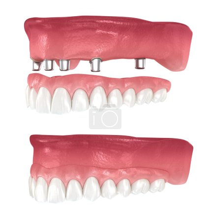 Photo for Maxillary prosthesis supported by 2 teeth and 4 implants. Dental 3D illustration - Royalty Free Image