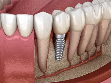 Photo for Periimplantitis with visible bone damage. Medically accurate 3D illustration - Royalty Free Image