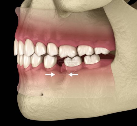 Photo for Teeth shift deformatiuon after losing molar tooth. 3D illustration of Popov Godon phenomenon - Royalty Free Image