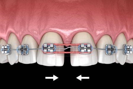 Elastiques et accolades métalliques pour la correction du diastème. Illustration 3D dentaire médicalement précise