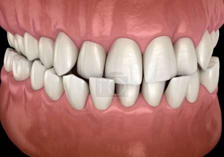Téléchargez les photos : Occlusion dentaire croisée antérieure (malocclusion des dents). Illustration 3D dentaire médicalement précise - en image libre de droit