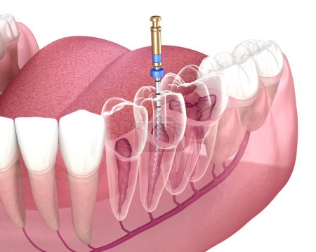 Endodontische Wurzelbehandlung. Medizinisch korrekte 3D-Darstellung der Zähne.
