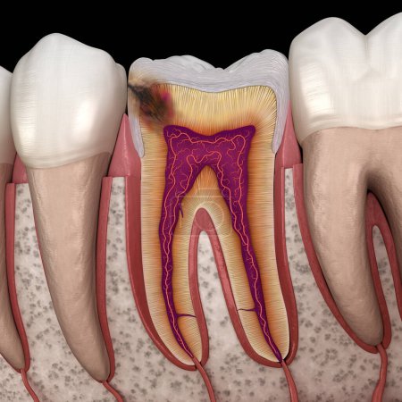 Téléchargez les photos : Des caries cachées dans la dent molaire. Illustration 3D médicalement précise - en image libre de droit