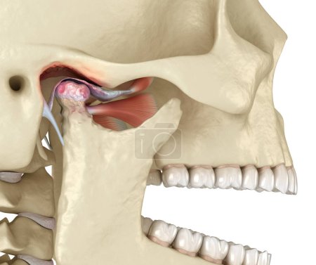 Artritis temporomandibular y dislocación del disco articular. Ilustración 3D médicamente precisa.