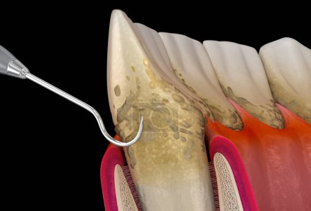 Photo for Oral hygiene: Scaling and root planing (conventional periodontal therapy). Medically accurate 3D illustration of human teeth treatment - Royalty Free Image