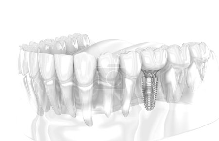 Téléchargez les photos : Implant dentaire et couronne en céramique. Illustration 3D des dents humaines - en image libre de droit