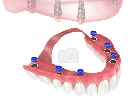 Photo for Removable prosthesis based on six implants. Dental 3D illustration - Royalty Free Image