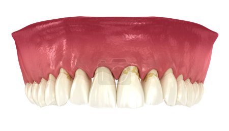 Parodontitis und Zahnfleischrezession. Medizinisch korrekte 3D-Darstellung