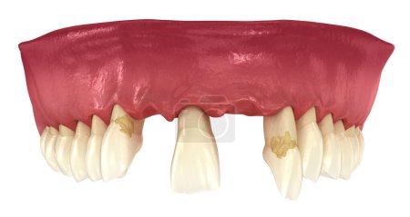 Photo for Periodontitis, gum recession and lost teeth. Medically accurate 3D illustration - Royalty Free Image