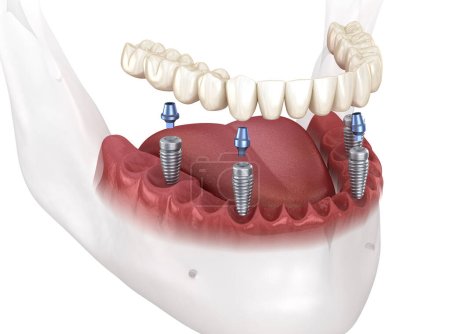 Photo for Dental rosthesis based on 4 implants. Dental 3D illustration - Royalty Free Image