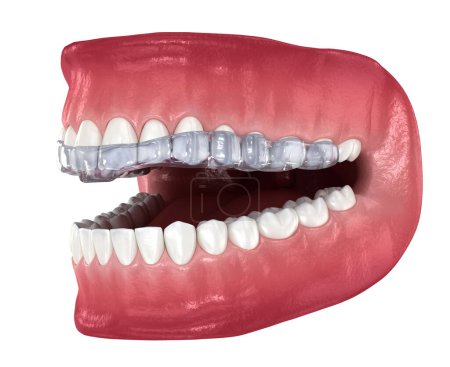 Attelle de morsure - correction de morsure. Illustration 3D dentaire médicalement précise