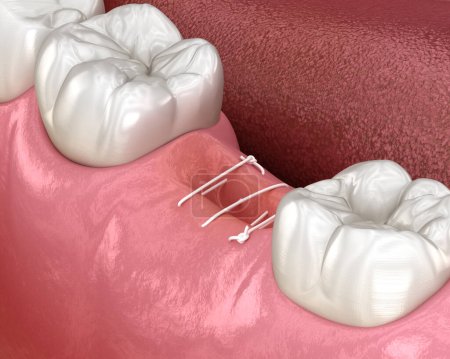 Foto de Stitches in gum after tooth extraction. 3D illustration of dental treatment - Imagen libre de derechos