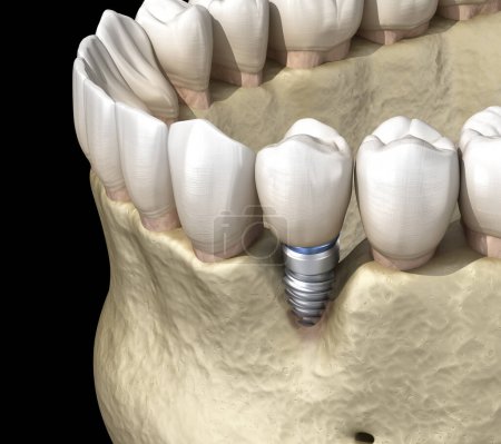 Periimplantitis mit sichtbarer Knochenrezession. Medizinisch korrekte 3D-Abbildung des Zahnimplantat-Konzepts