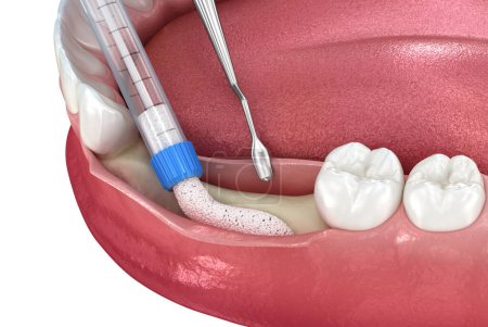 Augmentation de greffe osseuse pour implantation dentaire. Illustration 3D médicalement précise.