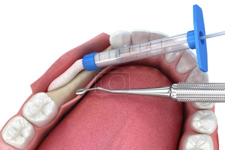 Augmentation von Knochentransplantaten zur Implantation von Zähnen. Medizinisch korrekte 3D-Darstellung.