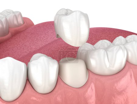Colocación de dientes premolares y corona dental preparada. Ilustración 3D médicamente precisa