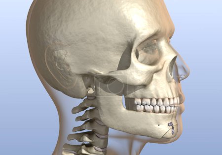 Photo for Chin Reduction (Osseous Genioplasty) surgery. Medically accurate dental 3D illustration. - Royalty Free Image