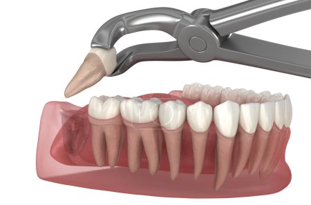 Foto de Extracción de muela del juicio. Ilustración 3D de dientes médicamente precisos. - Imagen libre de derechos