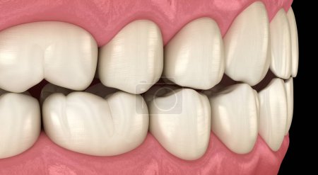 Photo for Traumatic Occlusion. Medically accurate 3D illustration - Royalty Free Image