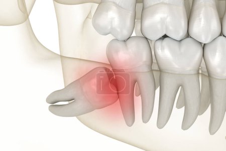 Impacto mesial de las muelas de Sabiduría. Ilustración 3D de dientes médicamente precisos