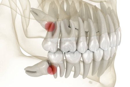 Foto de Impacto mesial de las muelas de Sabiduría. Ilustración 3D de dientes médicamente precisos - Imagen libre de derechos