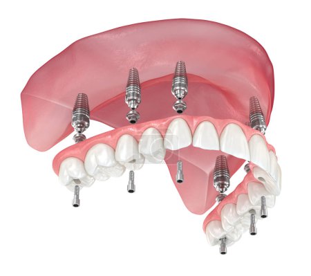 Photo for Maxillary prosthesis with gum All on 6 system supported by implants. Dental 3D illustration - Royalty Free Image