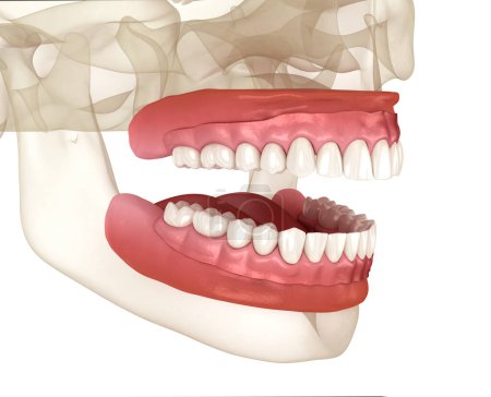 Photo for Removable prosthesis, artificial gum and teeth. Dental 3D illustration - Royalty Free Image