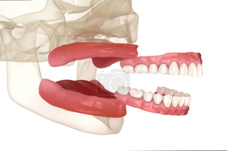 Herausnehmbare Prothese, künstliches Zahnfleisch und Zähne. Zahnärztliche 3D-Illustration