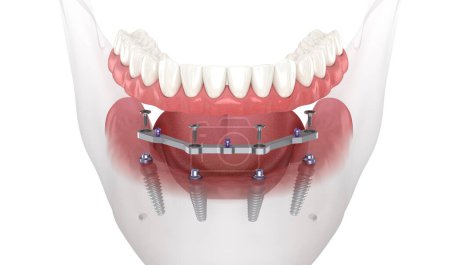 Photo for Mandibular prosthesis with gum All on 4 system supported by implants. Medically accurate 3D illustration - Royalty Free Image