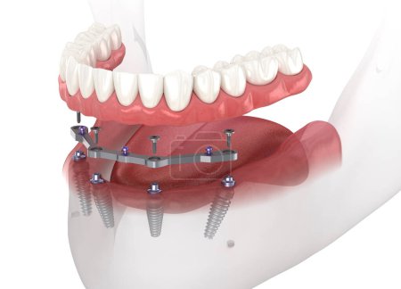 Unterkieferprothese mit Zahnfleisch All-on-4-System, das durch Implantate unterstützt wird. Medizinisch korrekte 3D-Darstellung