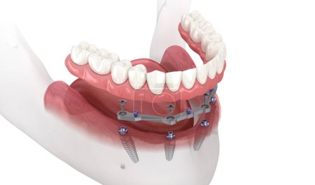 Téléchargez les photos : Prothèse mandibulaire avec gomme Tout sur 4 système soutenu par des implants. Illustration 3D médicalement précise - en image libre de droit
