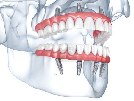Téléchargez les photos : Prothèses soutenues par 8 implants. Illustration 3D dentaire - en image libre de droit