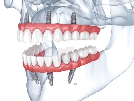 Photo for Prostheses supported by 8 implants. Dental 3D illustration - Royalty Free Image