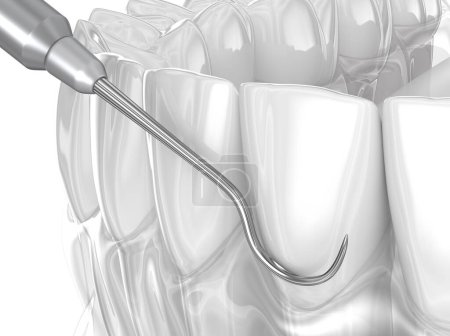 Photo for Scaling and root planing (periodontal therapy). Medically 3D illustration - Royalty Free Image