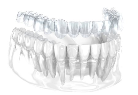 Invisaligne Zahnspangen oder unsichtbare Halter führen zur Bisskorrektur. 3D-Illustration