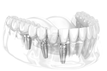 Photo for Dental bridge based on 3 implants. Dental 3D illustration - Royalty Free Image