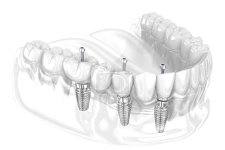 Téléchargez les photos : Pont dentaire basé sur 3 implants. Illustration 3D dentaire - en image libre de droit