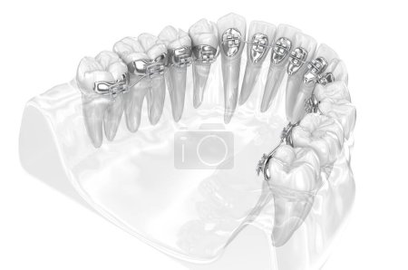 Photo for Lingual braces system. 3D illustration concept of golden braces - Royalty Free Image